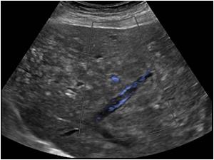 With color doppler again there is flow along the thrombus