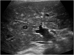 Thronbus in the hepatic vein