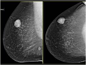 The first mammography from 2009