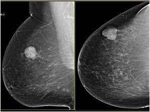Mammography from 2011