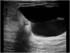 Ultrasound image Do you see the abnormality?