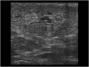 Ectopic mammary gland in the axilla during lactation