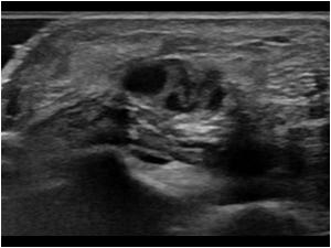 Transverse image of the abnormal arterial wall