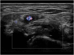 normal transvere image with flow