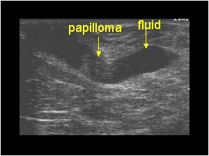 intraductal papilloma breast ultrasound)