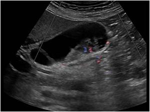 Another image with flow in the mass. The common bile duct is normal
