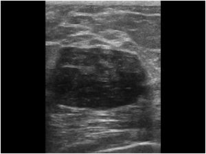 Transverse image from the mass in 2008 Biopsy showed a fibroadenona