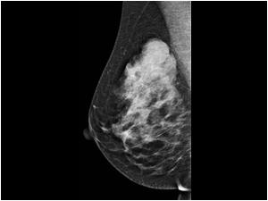 Mammography in 2008