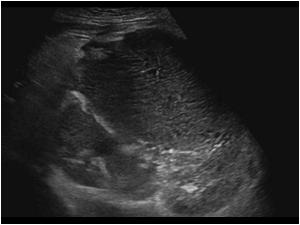 Another longitudinal image of the right kidney with the large mass