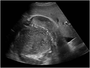Transverse image of the mass and right kidney