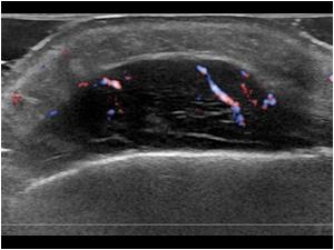 With color doppler this part is vascularized