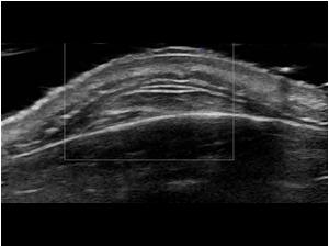 Although the mass is solid it has no vascularity with color doppler