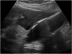 There is an abnormal echogenic anterior wall of the gallbladder is this air or calcium?