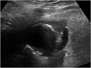 Another image showing some fluid around the gallbladder and a gallbladderwall defect and possibly some airbubbles outside the gallbladder