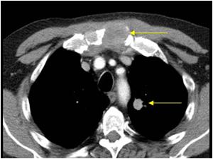 The CT scan shows a lungcarcinoma abd a metastasis in the sternum