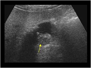 Gallbladder carcinoma with a mass