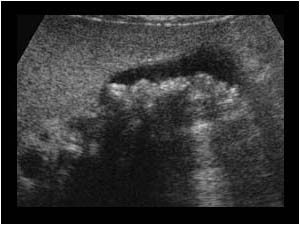 Gallbladder carcinoma with gallstones