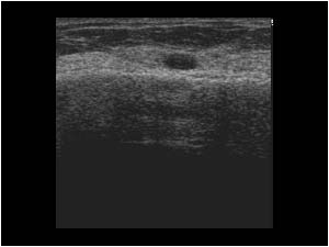 Intraglandular cyst in the right breast