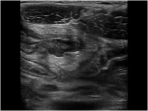 Another longitudinal image Is this the appendix?