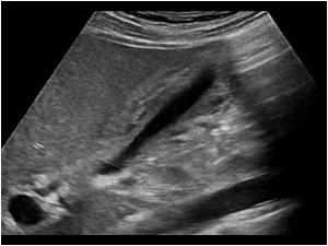 Thickened gallbladderwall in a young male patient