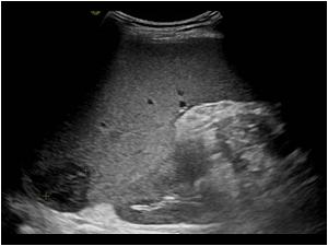 Image of the spleen with a small hypoechoic area