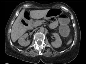 This is a CT scan of another female patient who is 70 years old who has abdominal pain and air in the gallbladder. The gallbladder is completely filled with air. Is this also an emphysematous cholecystitis?