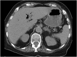 This is a CT image showing air in the intrahepatic bile ducts
