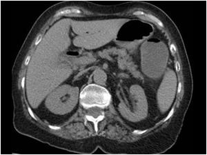 This CT scan shows air in the common bile duct