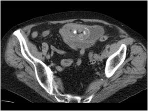 This is a CT image of the dilatated small bowel and the obstructing gallstone, which had perforated to the digestive tract and because of its size had caused a bowel obstruction.