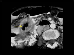 Gallbladder carcinoma