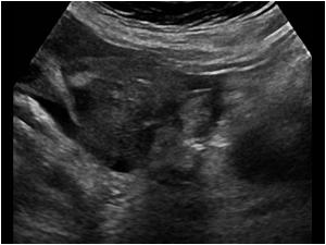 The mass is at the site of the right ovary