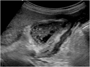 Another image of the abnormal gallbladder with surrounding mass