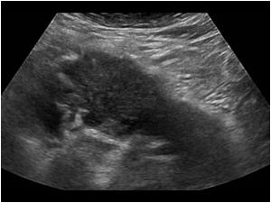 Transverse image of a swollen hypoechoic pancreas