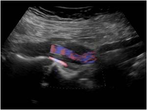 Longitudinal image of the aorta with color doppler