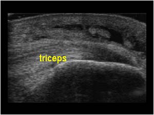 Olecranon bursa and triceps tendon longitudinal