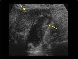Abnormal thickening of the gallbladder wall