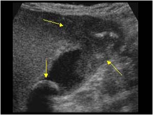 Abnormal thickening of the gallbladder wall and gallstone