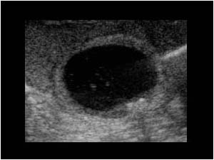 Gallbladder with sludge and small gallstones transverse