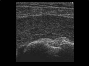 Bursa anterior of the bicipital groove with synovial thickening transverse