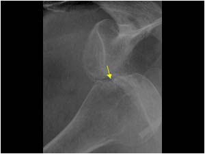 Humeral head luxation