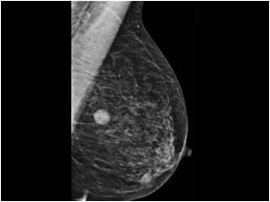 Mammography left breast MLO