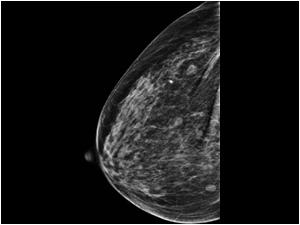 Mammography Right breast CC