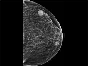 Mammography Left breast CC