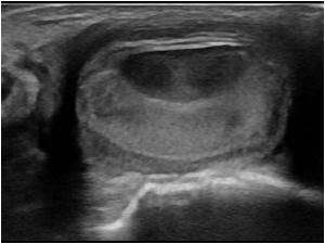 Transverse image of the lesion on the dorsal side of the ankle