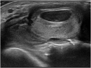 Longitudinal image of the lesion on the dorsal side of the ankle