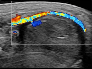 Longitudinal image with color shows the artery with a small neck  entering the lesion