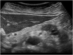 Transverse image with a lesion in the corpus of the pancreas