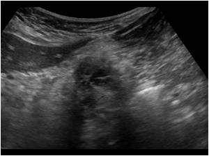 Longitudinal image of the mass showing some small cysts