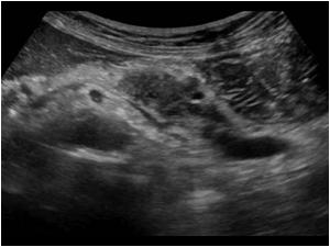 Transverse image showing a dilatated pancreatic duct in the tail distal to the mass