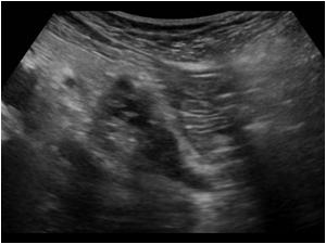 Another transverse image showing atrophy of the pancreatic tail